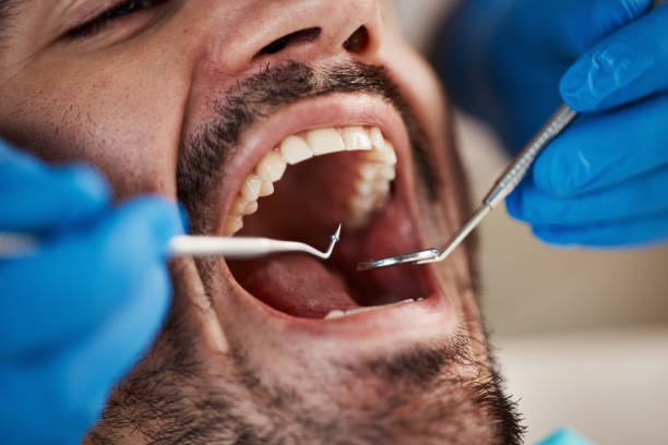 Best Emergency Treatment for Dental Infections or Abscesses in Fulton, MD