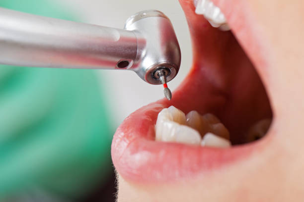 Best Emergency Dental Care for Broken or Chipped Teeth in Fulton, MD